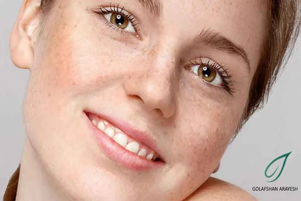 عوامل مختلف ایجاد کک و مک