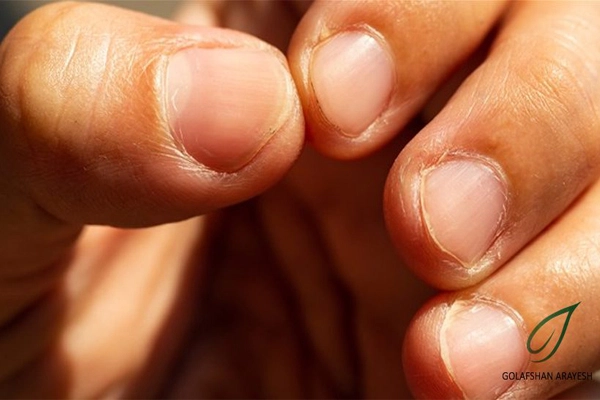 کشف بیماری از طریق سلامت ناخن ها