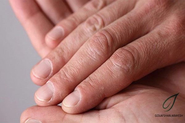 اختلالات شایع ناخن ها