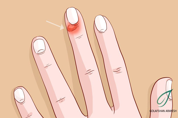 عفونت ناخن ها