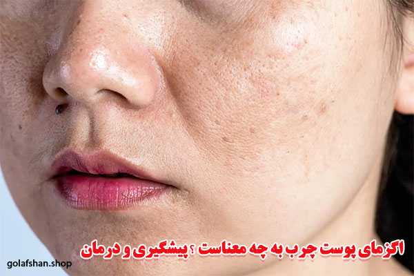 اگزمای-پوست-چرب-به-چه-معناست-پیشگیری-و-درمان