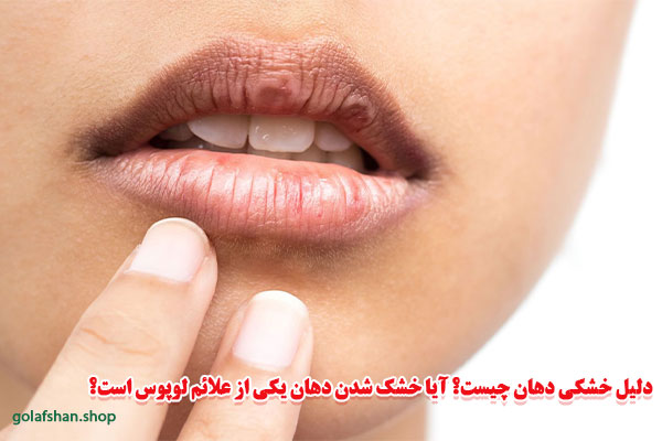 دلیل خشکی دهان چیست؟ آیا خشک شدن دهان یکی از علائم لوپوس است؟
