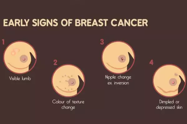 علائم سرطان سینه در زنان