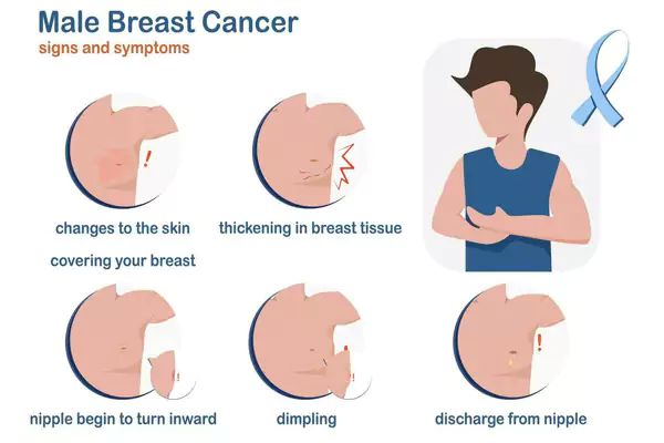 علائم سرطان سینه در مردان