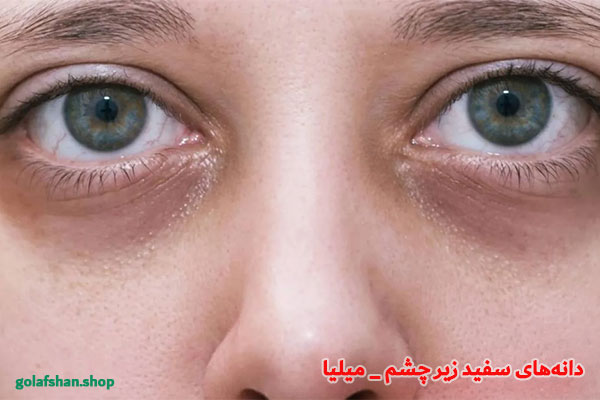 دانه‌های-سفید-زیر-چشم-_-میلیا