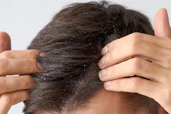 علت شوره سر چیست