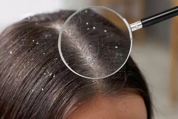 درمان قطعی شوره سر چیست