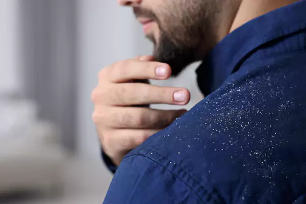 علائم شوره سر چیست